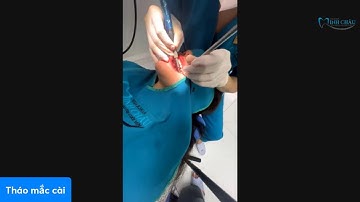 Tháo niềng đón Tết