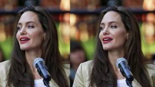 Bell's Palsy  The facial paralysis that's affected A listers like Angelina Jolie and George Clooney