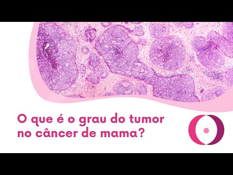 Vídeo: Quão raro é o câncer de mama metaplásico?