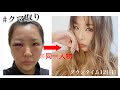 【整形のリアル】クマ取ったらダウンタイム中なのに美人になった😂💗