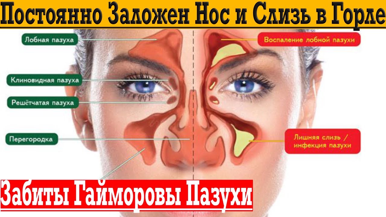 Почему постоянно заложен нос и слизь в горле, гайморит! - YouTube