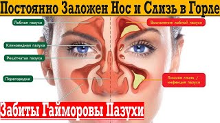 картинка: Почему постоянно заложен нос и слизь в горле, гайморит!