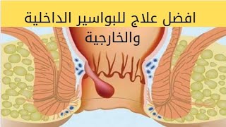 علاج مرض البواسير بالاعشاب / علاج البواسير خلال دقيقتين فقط / البواسير الخارجية المنتفخة