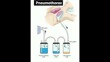pneumothorax #shorts #shorts #shortsfeed #shortsfeed #doctor #shortsvideo #short #mbbs #baby #neet