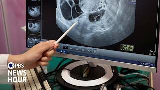 How new findings on ovarian cancer origins may help reduce risk