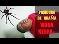 Sr  Pedro Guzmán - Paciente con Picadura de Araña Viuda Negra