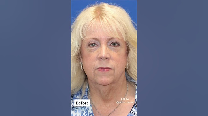 Incredible Facelift Took 20 Years Off!