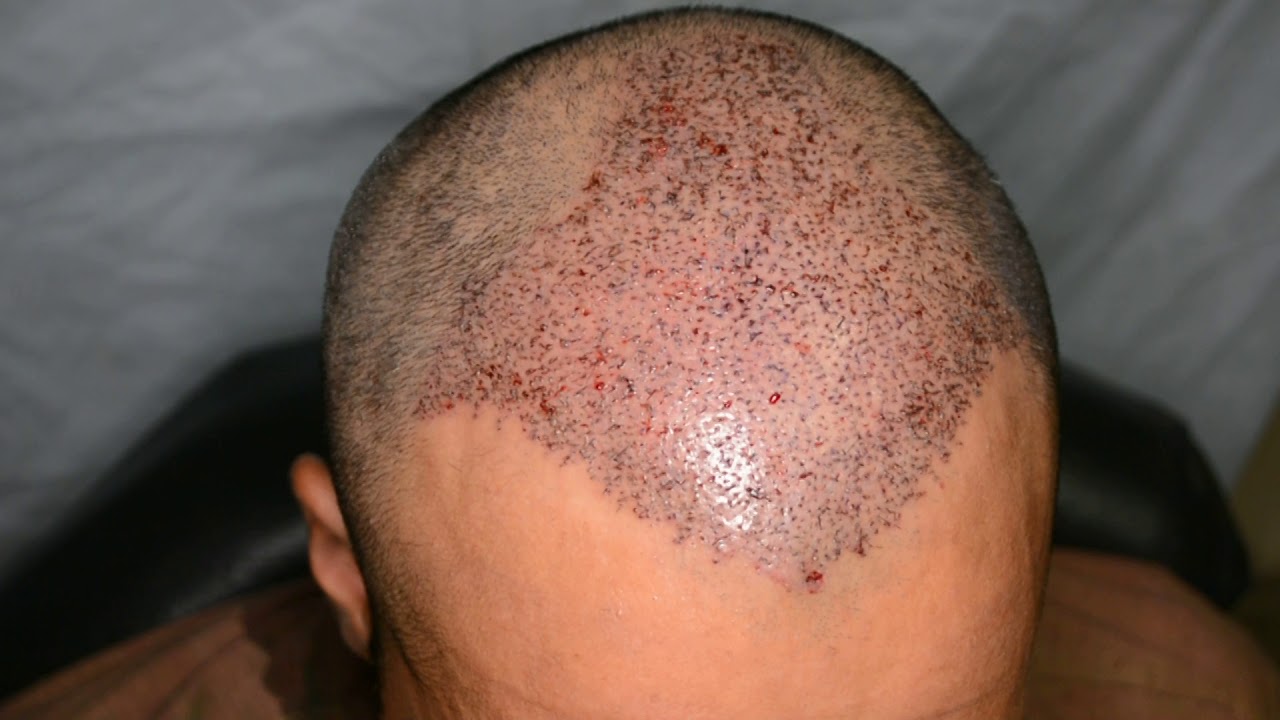 Jeddah patient Fue hair transplant 3376 grafts Cost 5500 Saudi Riyal