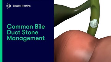 How to Manage Common Bile Duct Stones