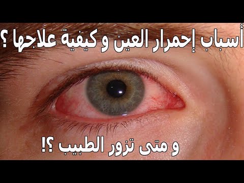 أسباب إحمرار العين و علاجها و متى تزور الطبيب ؟! Red Eye