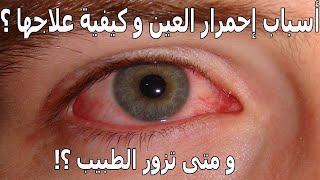 أسباب إحمرار العين و علاجها و متى تزور الطبيب ؟! Red Eye