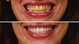 Finalmente dentes brancos! 9 truques caseiros de beleza que realmente funcionam