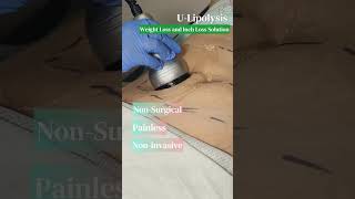 U-lipolysis weightloss Treatment, Medical-Centered Approach (non-surgical, non-invasive, no pain) U-lipolysis weightloss Treatment, Medical-Centered Approach (non-surgical, non-invasive, no pain)