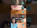 6 Ways PCOS Can Show Up on Your Skin | Polycystic Ovary Syndrome