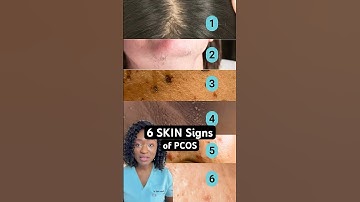 6 Ways PCOS Can Show Up on Your Skin | Polycystic Ovary Syndrome