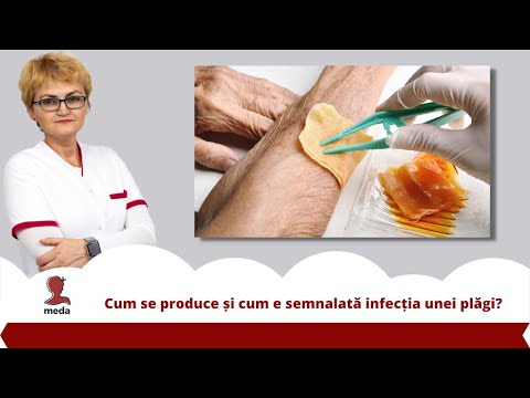 Video: Tratamentul Plăgilor - Curățarea Plăgii - Infecția Plăgii