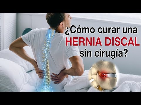 ¿Cómo curar una Hernia Discal lumbar sin cirugía? Tratamiento efectivo