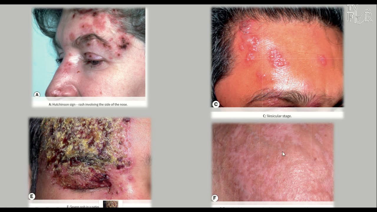 Ceratites e Conjuntivites Virais - Claudia Antunes Magalhães - Córnea