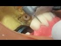 圧接法による仮歯作成(6/15)タービンヤリ状バーで口腔内で形を作る