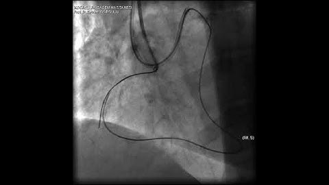 Aortic dissection and radial rupture during retrograde CTO PCI: Management of complications VİDEO 12