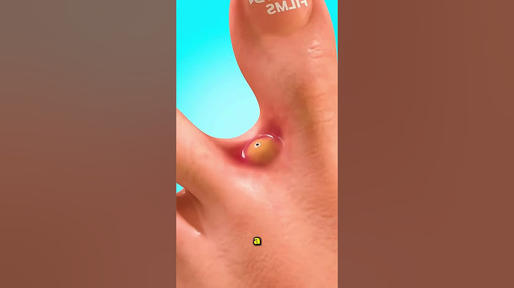 This Is What Mosquitoes Do When They Bite You 😮
