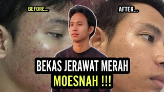 DERMAPEN REVIEW HARI KE HARI - GA NYANGKA JADI GINI