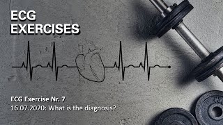 ECG Exercise Nr. 7: What is the Diagnosis