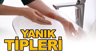 Yanık Çeşitleri Ve Tipleri Ayşegül Aksu
