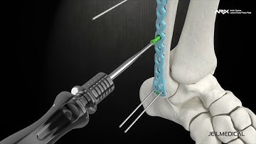 [ARIX OS] ARIX Distal Fibula Surgical Guide