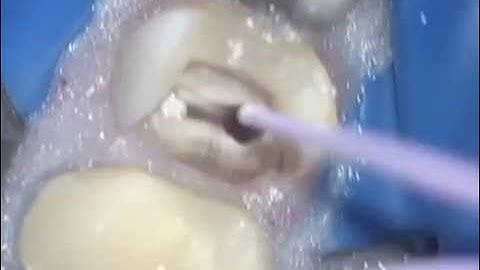 Bioceramic Obturation