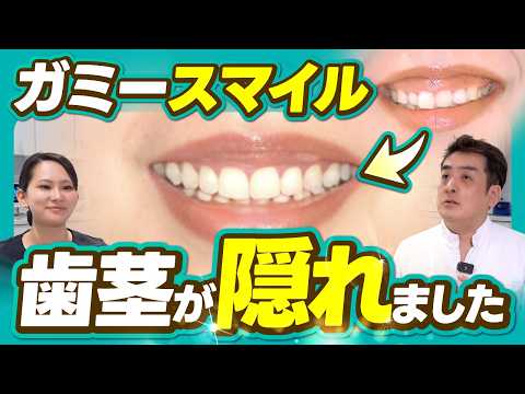 Gummy Smile] Self-conscious about showing your gums? A case study