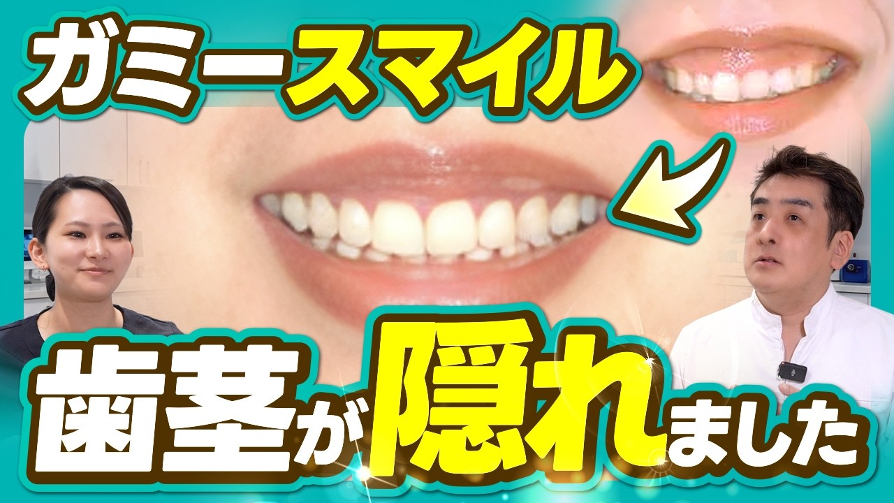 Gummy Smile] Self-conscious about showing your gums? A case study