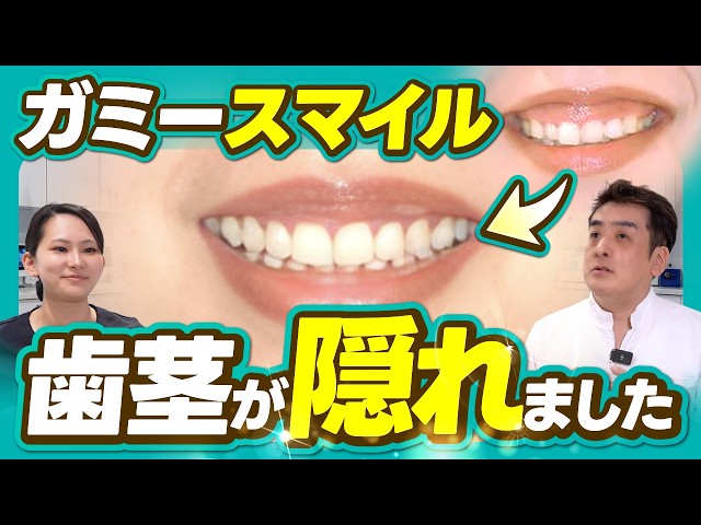 Gummy Smile] Self-conscious about showing your gums? A case study