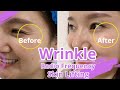 Rf skin tightening  rf wrinkle removal  wrinkle reduction skin tightening  32j3 mychway