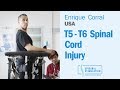 Enrique T5-T6 Spinal Cord Injury Patient from USA Undergoes Epidural Stimulation Surgery