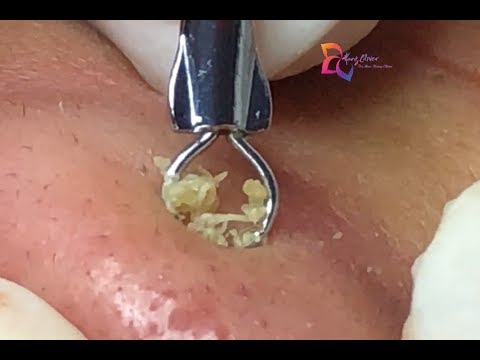 Blackheads Removal On The Nose For Quý | Hang Oliver | Part 
