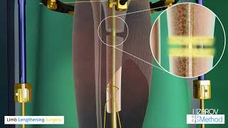 Limb Lengthening Surgery - Ilizarov Method - Livelifetallercom
