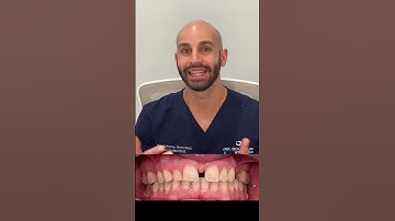 How We Close A Large Front Gap With Invisalign