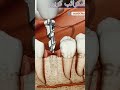 Dental implant#important