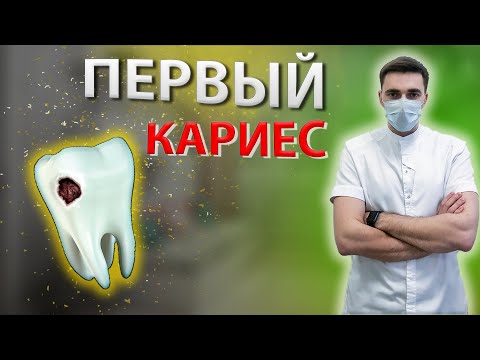 ЗУБЫ КОТОРЫЕ, ПОРАЖАЮТСЯ КАРИЕСОМ САМЫЕ ПЕРВЫЕ! Как предотвратить?