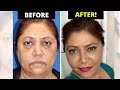 Unreal facelift before and after  she looks 20 years younger