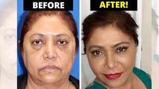 UNREAL Facelift Before and After | She Looks 20 Years Younger!!