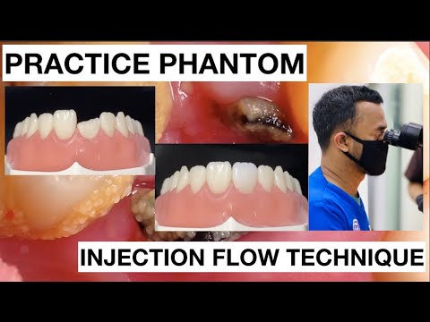 Step by Step Injection Flow Anterior Composite | Finishing Polishing | General Dentist Griya RR
