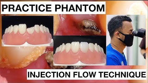 Step by Step Injection Flow Anterior Composite | Finishing Polishing | General Dentist Griya RR
