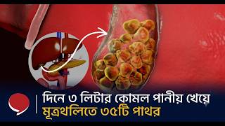 দিনে ৩ লিটার কোমল পানীয় পান করে মূত্রথলীতে ৩৫টি পাথর | DARK Reality of Alcoholic Drinks | Soft Drink screenshot 3