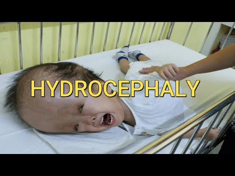 hydrocephaly