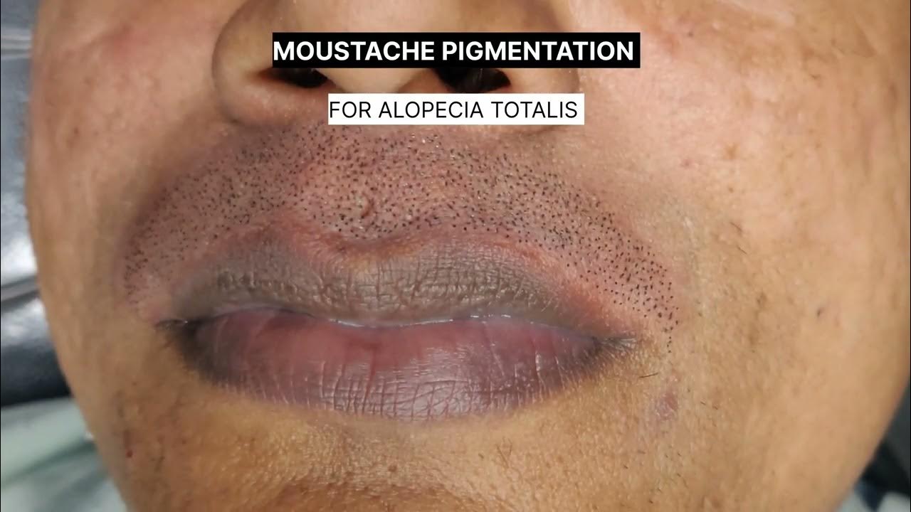 MOUSTACHE PIGMENTATION FOR ALOPECIA TOTALIS (SMP) 