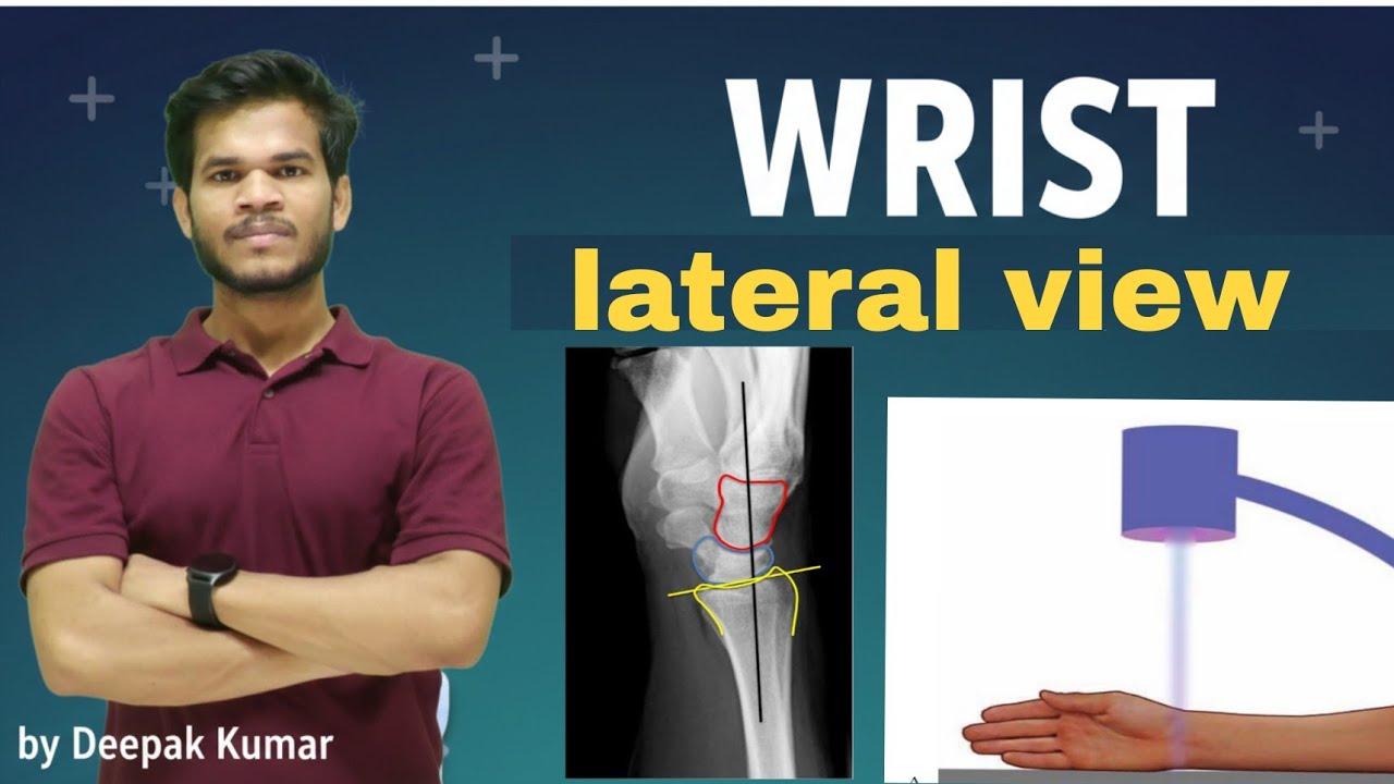 Wrist Lateral view l colle's Fracture lSmith's Fracture l Bartsons's Fracture l 