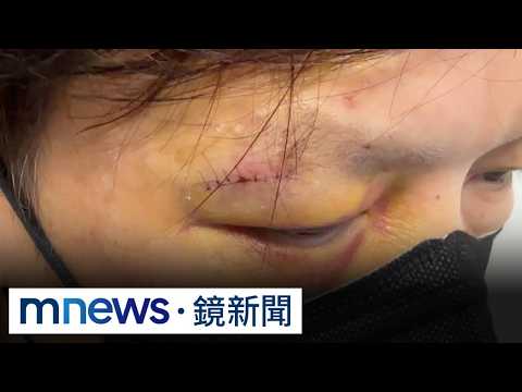 Beyblade Launcher Flies Out of Nowhere and Hits Man in the Face, Requiring Nearly 20 Stitches | #...