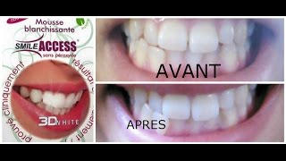 Blanchiment dentaire/ Smile access 3D white تجربتي مع تبييض الاسنان و رايي في